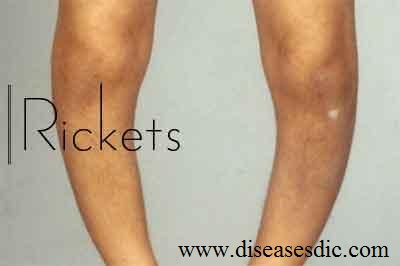 Rickets Causes And Effects