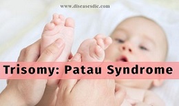 Pataus Syndrome Or Trisomy 13 Definition Causes And Treatment