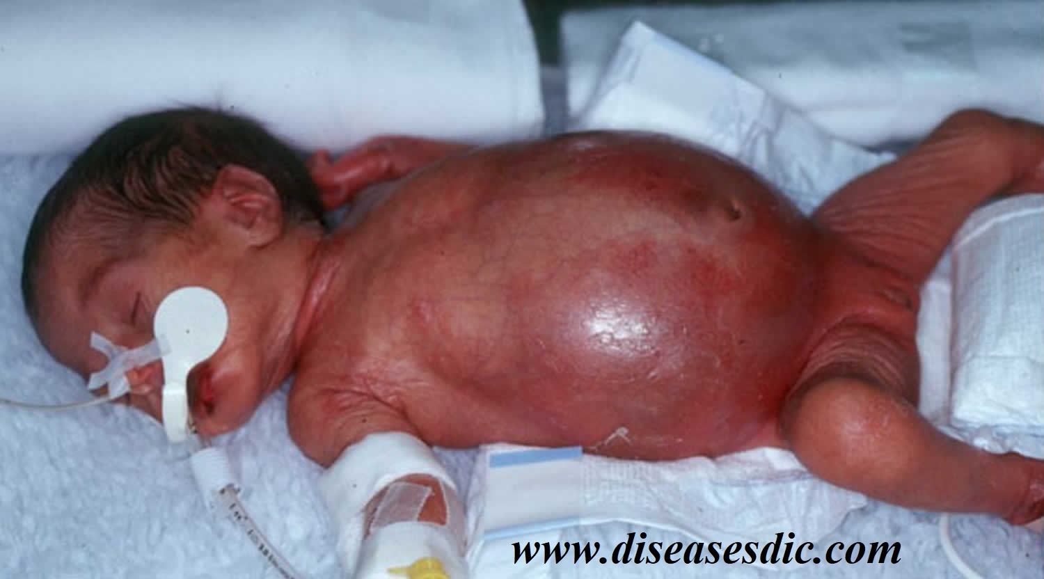 Why Would A 5 Day Old Baby Develop Necrotizing Enterocolitis?
