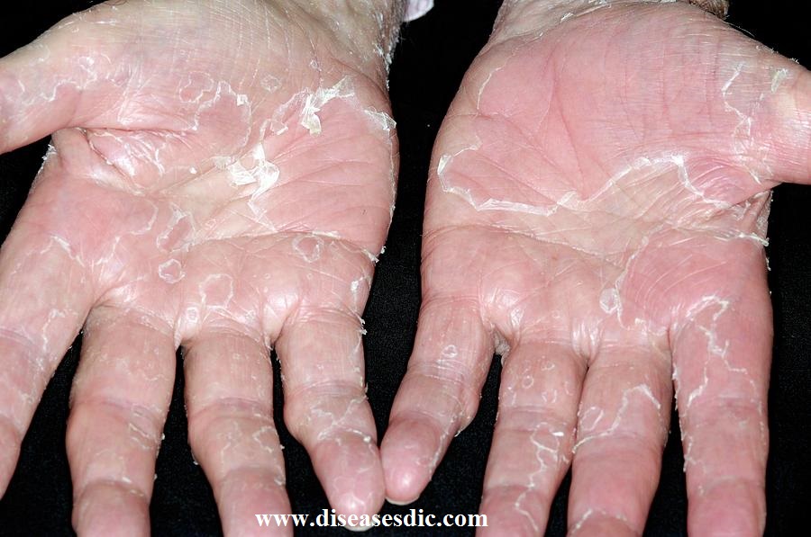 peeling-skin-syndrome-definition-treatment-and-prevention