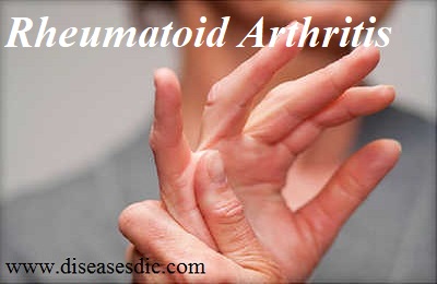 Rheumatoid Arthritis - History, Symptoms, and Prevention