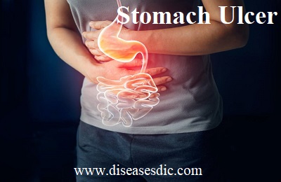 Stomach Ulcer - Symptoms, Treatment, and Prevention.