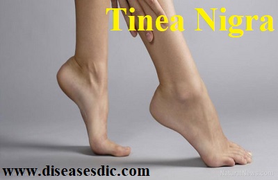 Tinea Nigra - Risk Factors, Symptoms, Treatment and Prevention. 