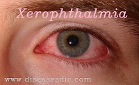 Xerophthalmia Definition Risk Factors And Treatments