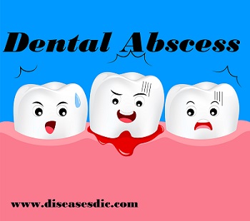 Dental abscess – Causes, Symptoms, and Treatment. -