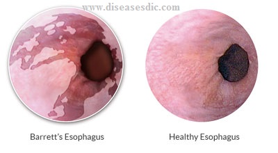 Barrett's esophagus- Symptoms, Treatment and Prevention