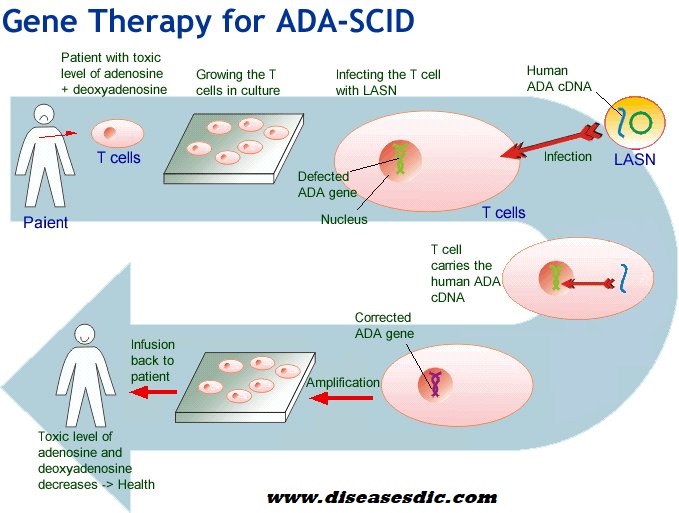 SCID symptoms what is ADA