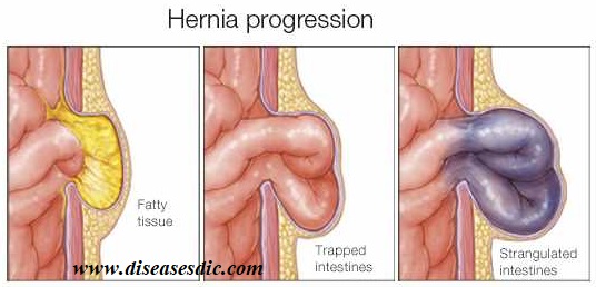 Hernia - Causes, Treatment, and Prevention.