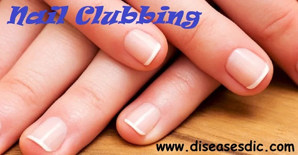 Nail Clubbing – Causes, Symptoms, and Treatment. -