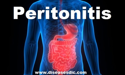 Peritonitis Symptoms, Causes, Treatment, and Prevention