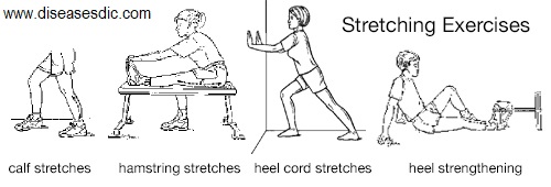 severs heel treatment