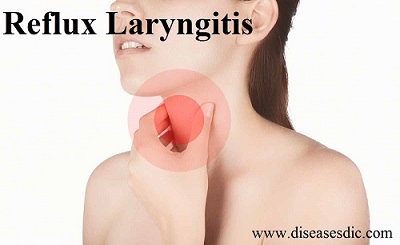 Acid reflux laryngitis home remedies