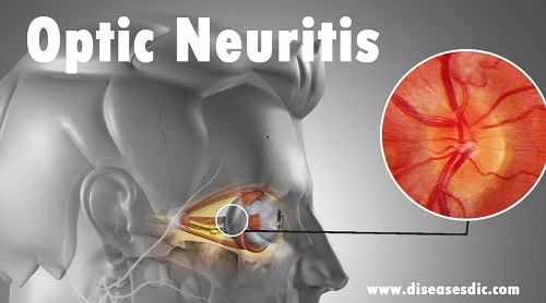 Optic Neuritis Causes Diagnosis And Management