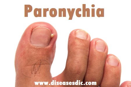 Paronychia Types Causes Treatment And Prevention