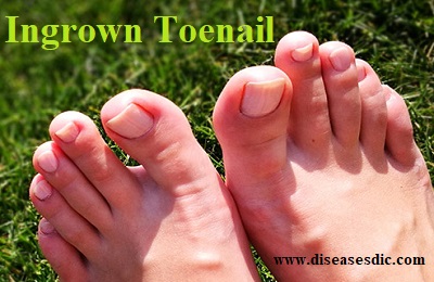 Ingrown Toenail – Causes, Risk Factors, and Treatment. -