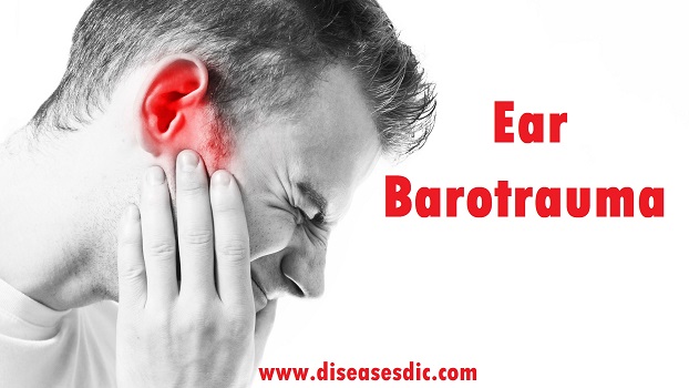 otitic barotrauma treatment