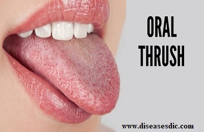 Oral Thrush – Symptoms, Causes, and Medications.