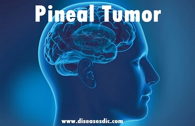 Pineal Tumor – Types, Risk Factors, Diagnosis and Treatment