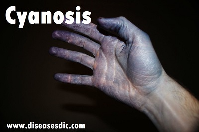 Cyanosis – Types, Pathophysiology, Symptoms and Causes