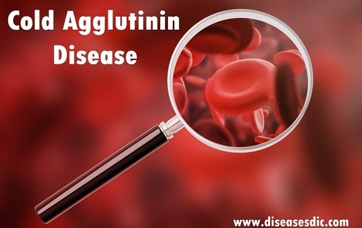Cold Agglutinin Disease (CAD) – Types, Causes and Diagnosis