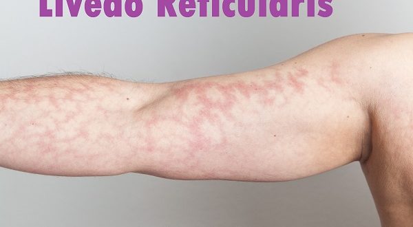 Livedo Reticularis Types Symptoms And Complications 