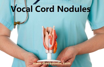 Vocal Cord Nodules – Causes, Risk Factors, and Prevention