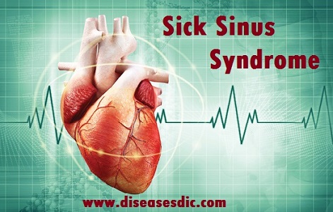 Sick Sinus Syndrome (SSS) – Types, Symptoms and Treatment