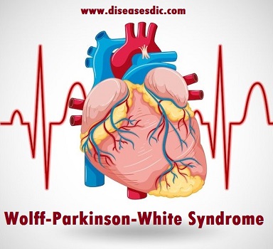 Wolff-Parkinson-White Syndrome (WPW) – Types, and Treatment